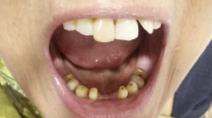 magicalsmiles before treatment