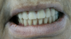 magicalsmiles after treatment