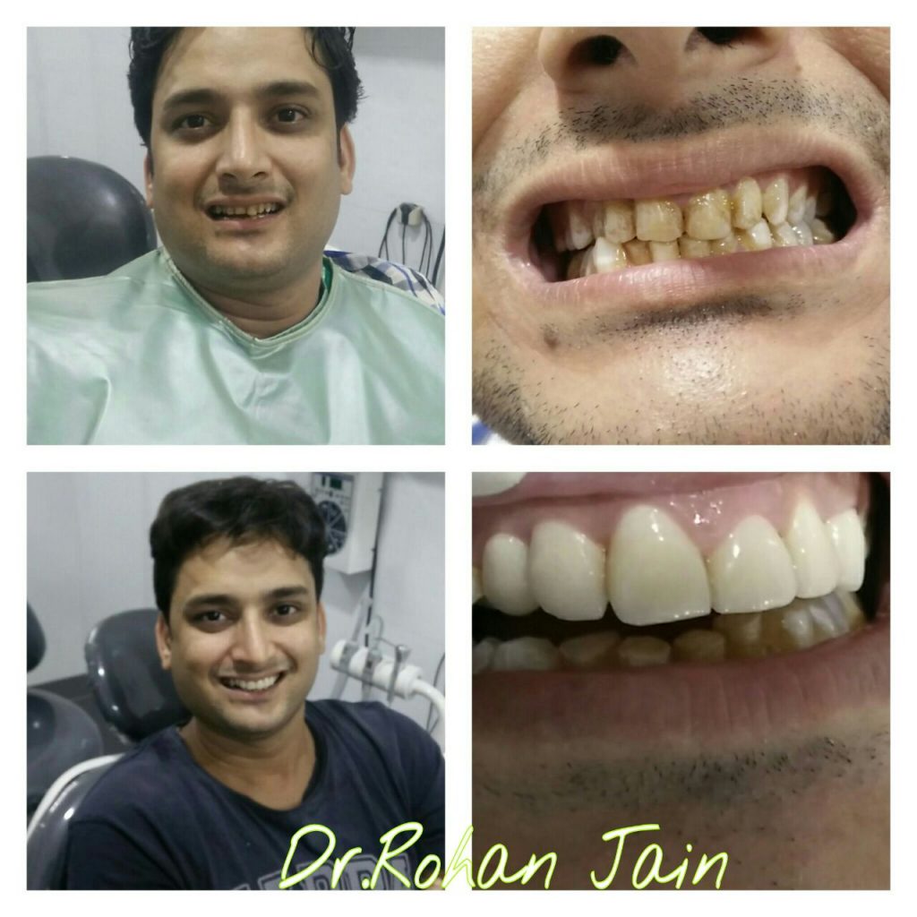 Teeth restoration - dental clinic Bhandup