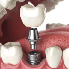 Why Dental Implants are Worth It?