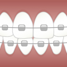 How dental braces work to straighten your teeth?