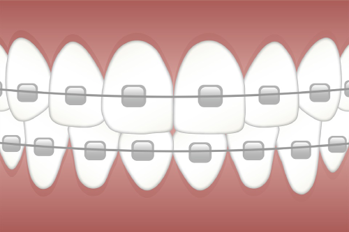 Dental Braces