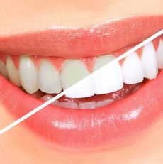 Some important Teeth Whitening Facts