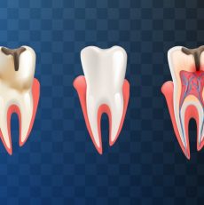 Things to Know Before Root Canal