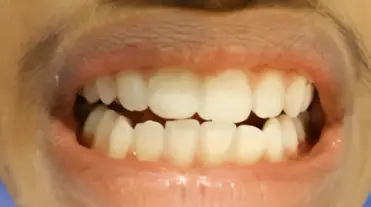 magicalsmiles after treatment