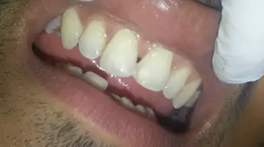magicalsmiles after treatment