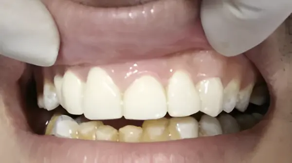 magicalsmiles after treatment